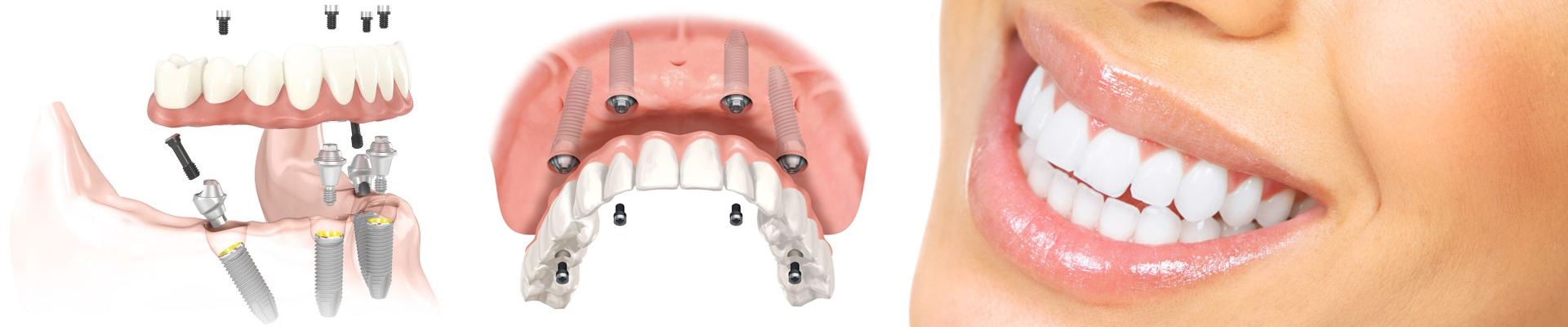 Tudo sobre 4 implantes dentários