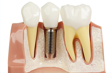 Bone Grafting