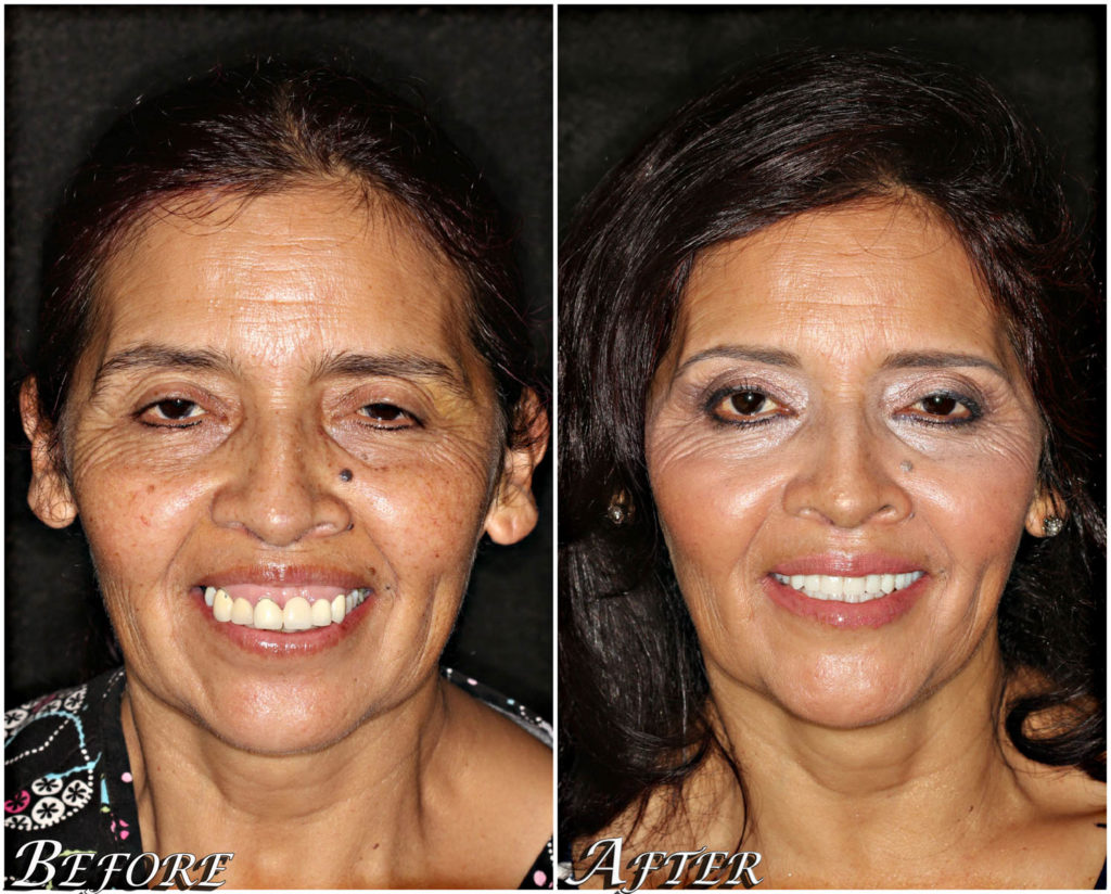 All On 4® Dental Implants Before And After Photos Center 4 Smiles 9793