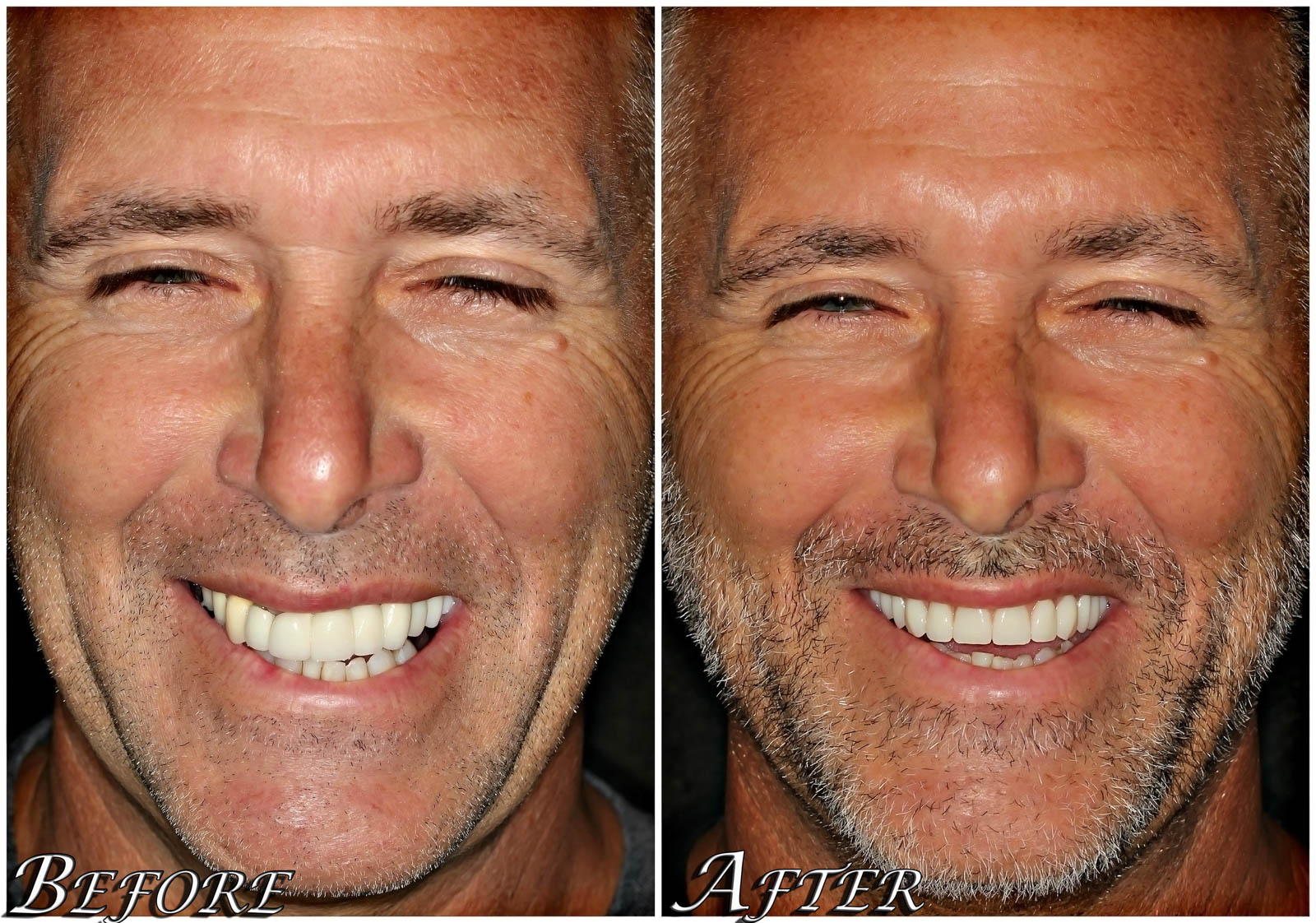 All on 4® Dental Implants Before and After Photos - Center 4 Smiles