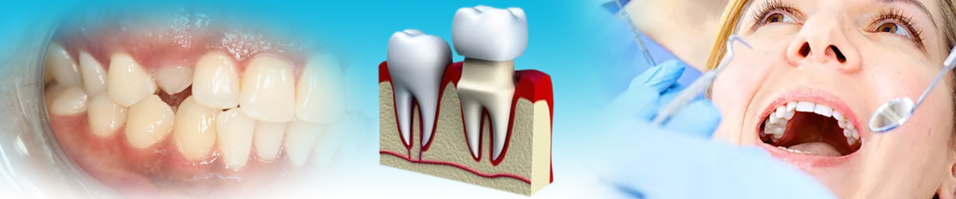 Crown Lengthening