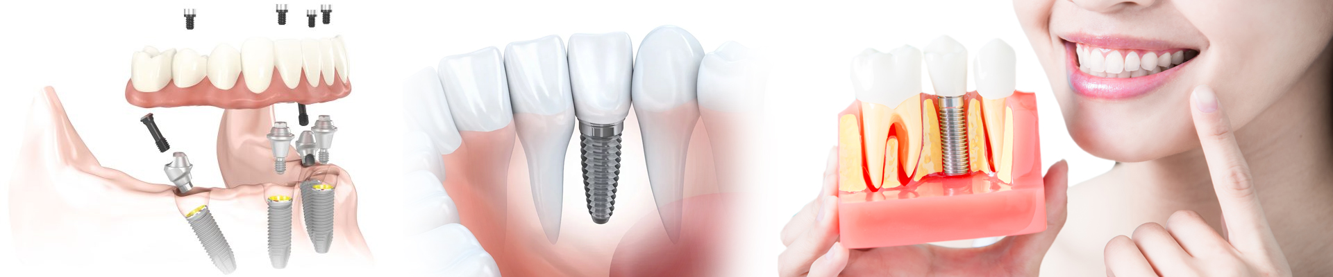 Implantes dentários