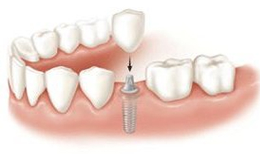 Implantes dentários