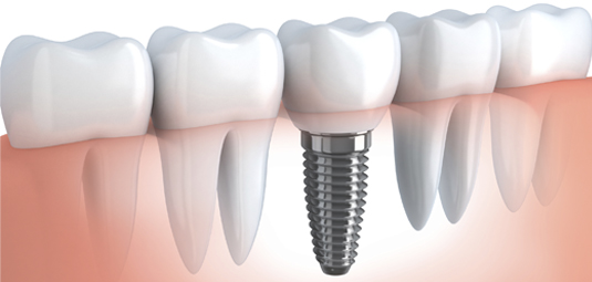 Implantes dentários