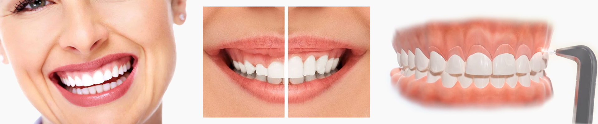 Gummy Smile Correction