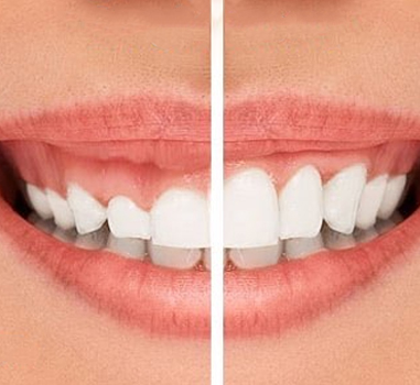 Gummy Smile Correction