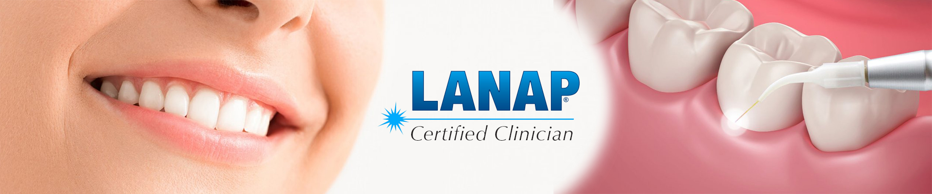 LANAP (новая процедура присоединения с помощью лазера)