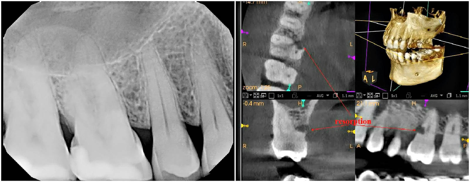 3D Root Canal Image
