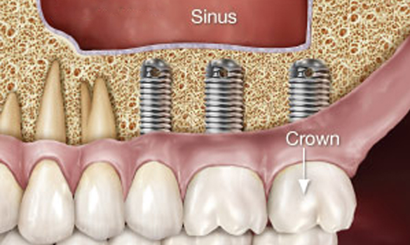 Sinus Grafting procedure