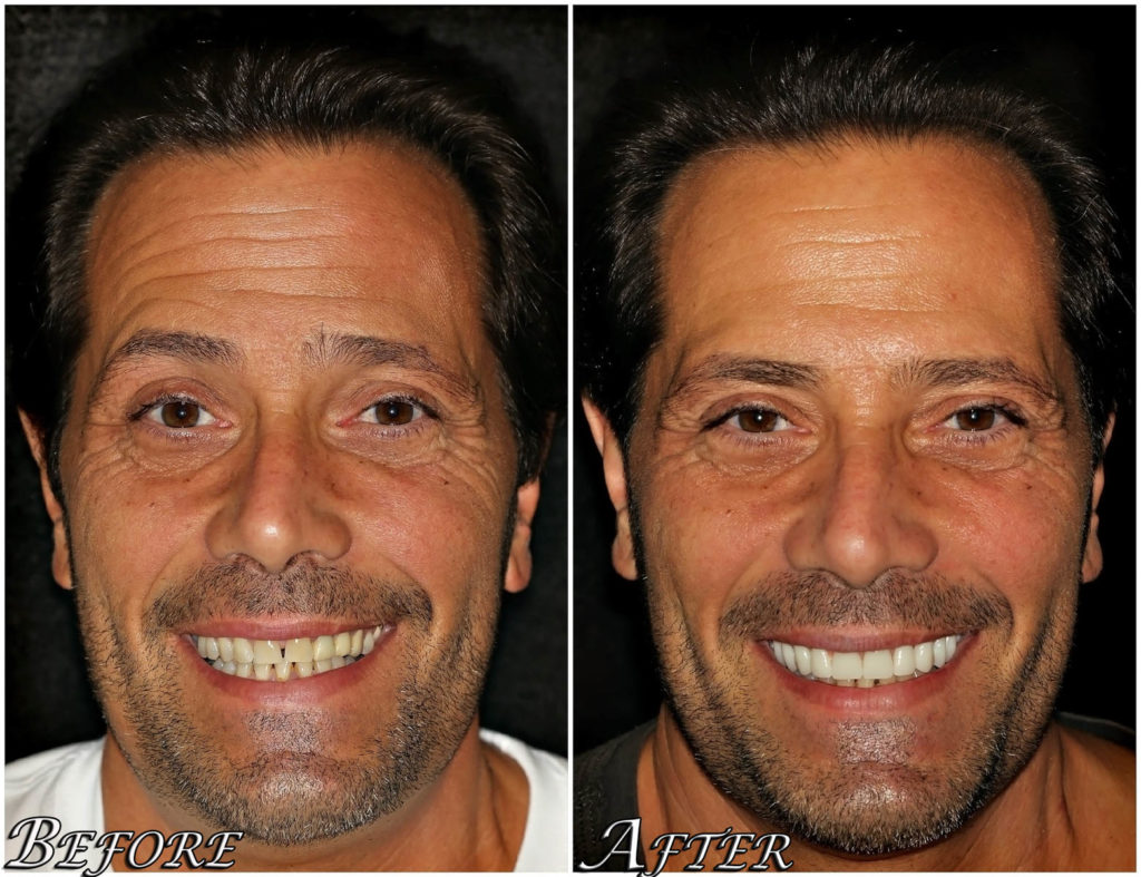 All on 4® Dental Implants Before and After Photos - Center 4 Smiles